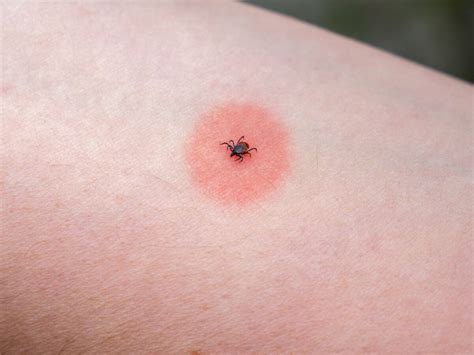 comment savoir  la tete de la tique est restee yahoo actualites