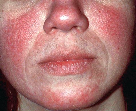 rosacea diagnosis  management   complex  significant disorder