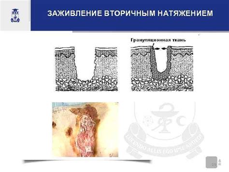 При наличии грануляционной ткани рана заживает. грануляция раны ...