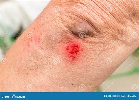 damaged  torn wound   elbow   blood   elderly person