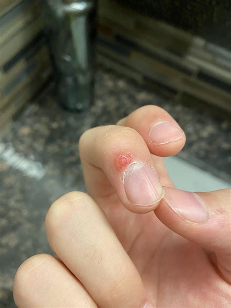 Should I still put compound w on when my wart looks like this? : r