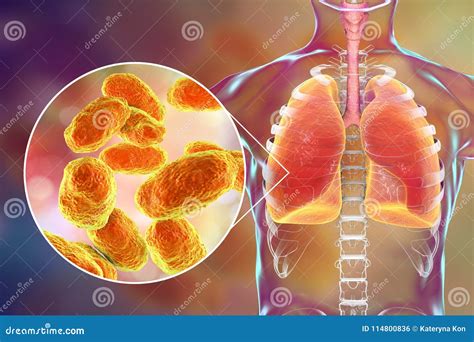 Pneumonia Caused By Haemophilus Influenzae Bacteria, Medical Concept ...