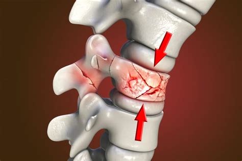 Osteoporosis Fracture Sites