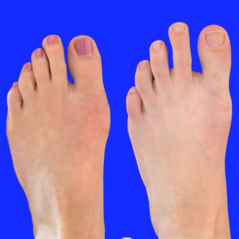 Bunionette Before And After