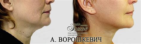 Липосакция подбородка