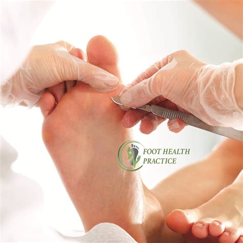 Bridgend South Wales Chiropodist Podiatrist Foot Health Foot Care Corn