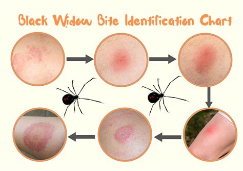 Black Widow Spider Bite Stages, Symptoms with Pictures (Identification)