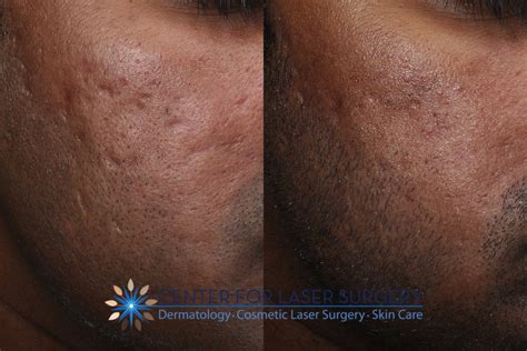Acne Scar Removal in Washington DC - Center for Laser Surgery