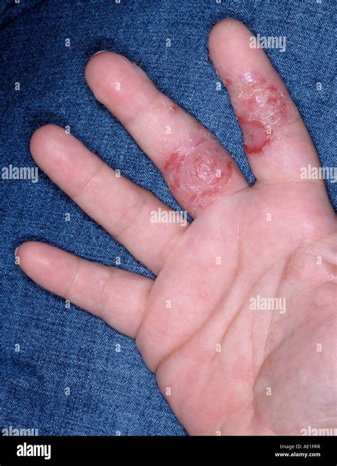 Photograph Dyshidrotic Eczema Science Source Images, 56% OFF