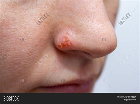 Herpes On Nose - Image & Photo (Free Trial) | Bigstock