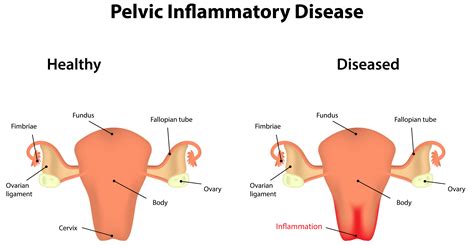 Natural & Herbal Remedies for Vaginal Infections & Yeast Infections