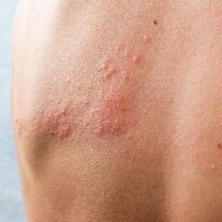 Shingles (Herpes Zoster) | Dermatologist In Munster, IN | SKIN Dermatology