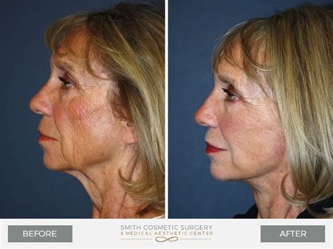 Mini Facelift Denver Before & After Photos | Facial Plastic Surgery Results