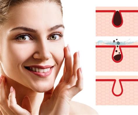 removing blackheads    chicago il med spa bella