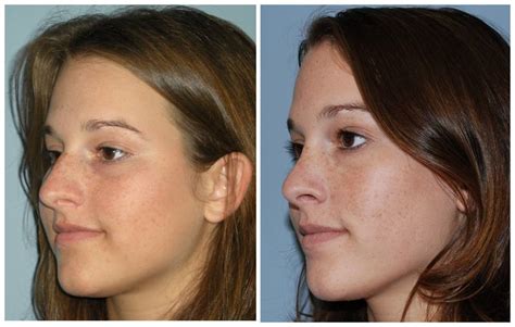 Septoplasty Only Before And After
