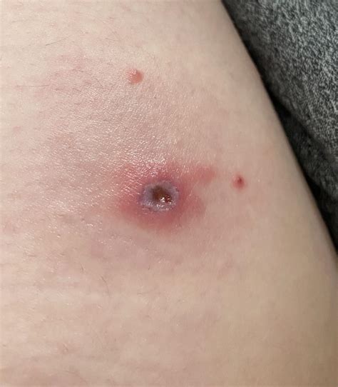 Spider bite 🫠 looks like this after almost a week. I’m on antibiotics
