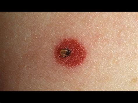 Normal Tick Bite Pictures