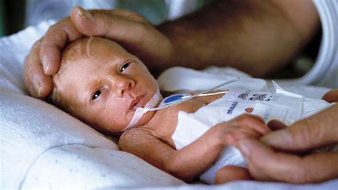 Survival Rate Improving for Extremely Preterm Babies | Preterm baby ...
