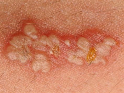 Herpes Cure – Is There a True Cure For Herpes? 