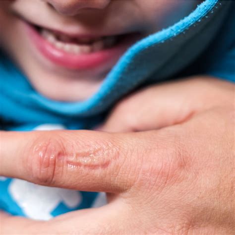 understanding  managing biting  toddlers parent blogger