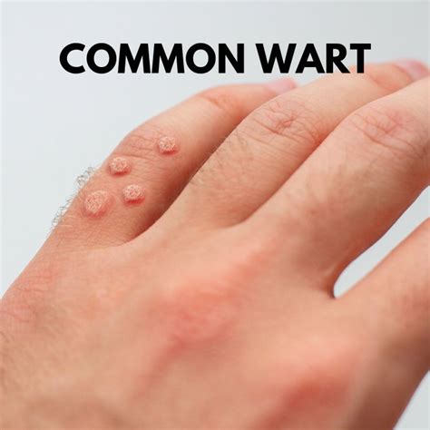 flat warts  palm