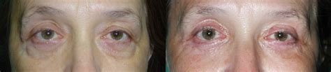 Blefaroplastika | Estetska Hirurgija Lica Dr Zivorad Nikolic