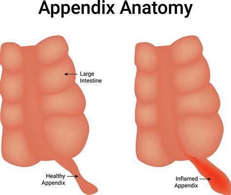 anatomy  appendix anatomy appendix vector art icons  graphics