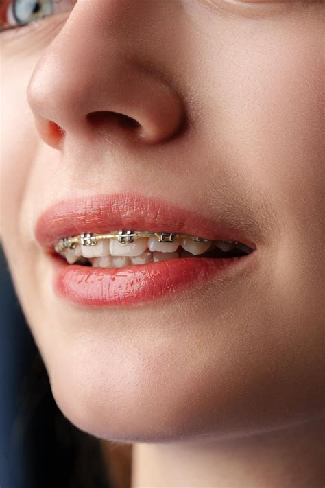 color de brackets para mujeres 2