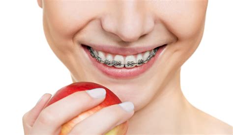 How Can Braces Fix An Overbite: Treatment Options And Duration