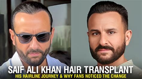 elon musk hair transplant   journey