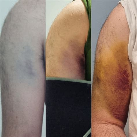 Fractured radial humerus, day 1 to day 5 of bruising : r/mildlyinteresting
