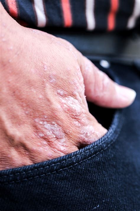 Preventing Winter Itch as Temperatures Drop