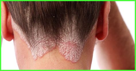 Top 11 Home Remedies To Cure Hair Fungus Naturally