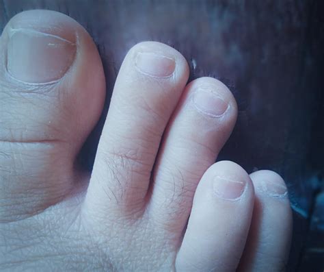 Abnormal Toe Growth