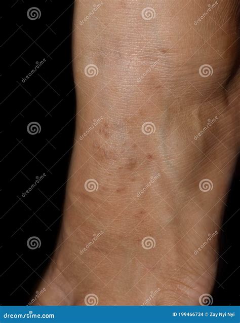 Skin. Molluscum Contagiosum Royalty-Free Stock Photo | CartoonDealer