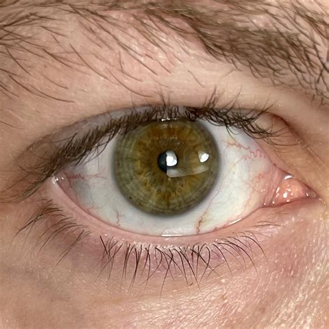 My interesting eyes. Prominent limbal rings. A lot of stress in my