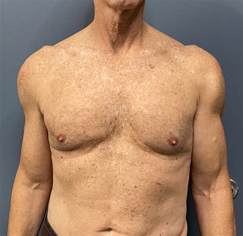 Plastic Surgery Case Study - Replacing Malpositioned and Fractured