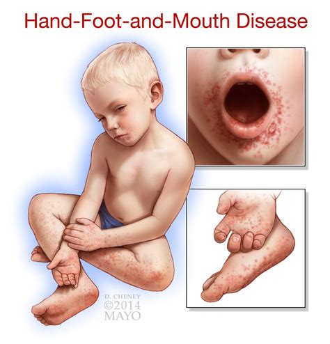 What are the best ways to treat a toddler with hand-foot-and-mouth