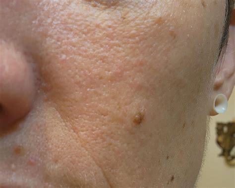 How do I get rid of this orange peel texture? : r/30PlusSkinCare