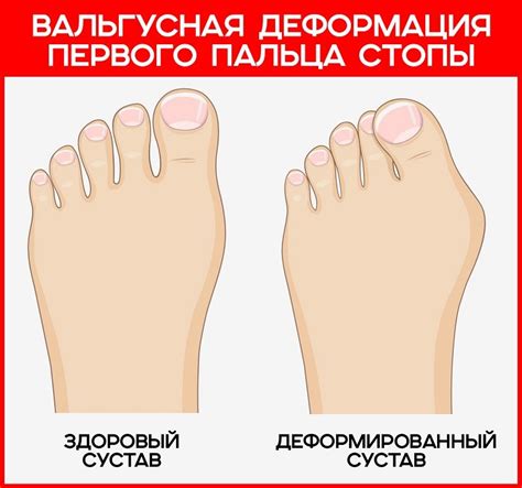Болят косточки на пальцах ног