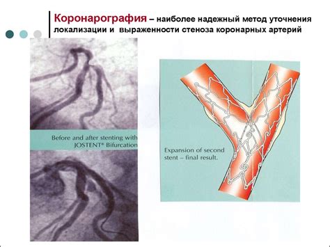 Ишемическая болезнь сердца. Клиническая лекция - презентация онлайн