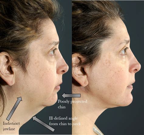 Chin Implant NYC — Lara Devgan, MD, MPH, FACS