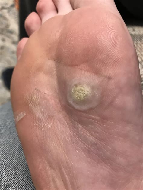 Treatment and Prevention Tips After Removing a Plantar Wart 26