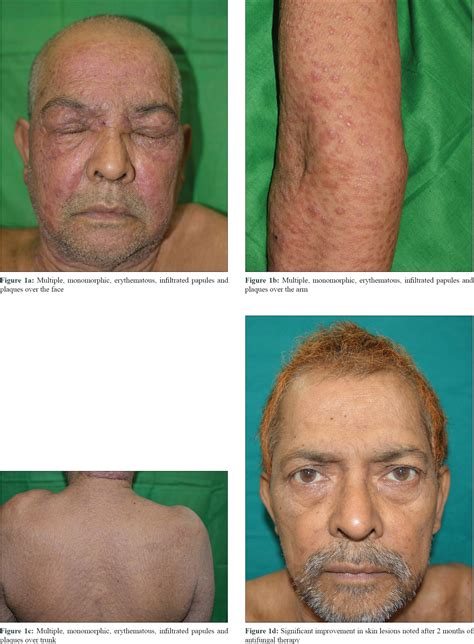 Histoplasmosis Skin