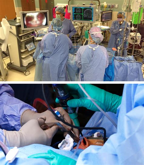 Principles of Endoscopic Microsurgery | The Neurosurgical Atlas
