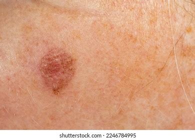 Close Mature Skin Precancerous Lesions Treated Stock Photo 2246784995 ...