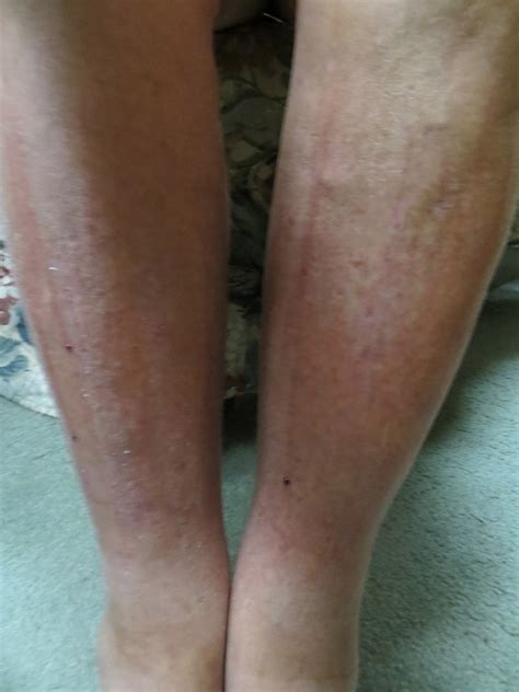 PrunePicker: Extreme itching! Front of lower legs.