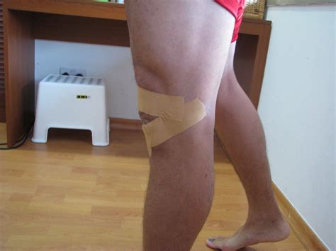 Fat Pad Irritation (Hoffa's Syndrome) | Core Concepts Singapore