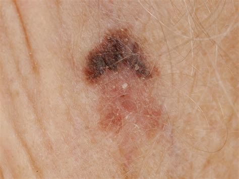 Histologia De Melanoma Lentigo Maligno Lentigo Maligna (Dubreuilh) En