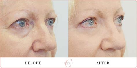 Non-Surgical Eyelid Lift Before & After | Cosmos Aesthetics